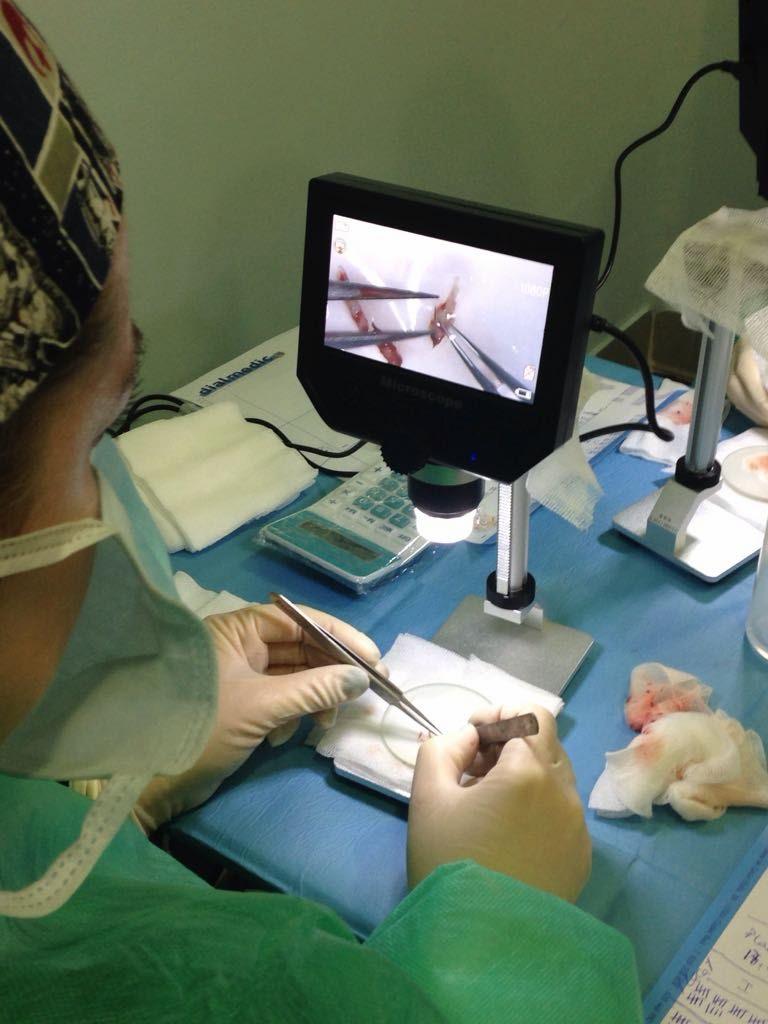 Preparación de injertos bajo microscopio durante un trasplante capilar FUE